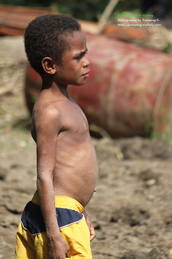 เดินทางเข้ามาตามชนบท ตามป่า ตามเขา... พบเห็นการเป็นอยู่แบบบ้านๆ 
เด็กคนนี้เป็นโรคผิวหนัง  :sad: