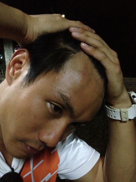 หัวโนตอนรถคว่ำ
