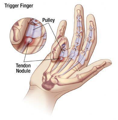 ใครรู้ตัวว่ามือชา โปรดอ่านให้จบ จะช่วยคุณได้ 